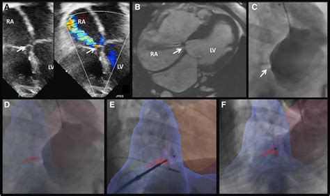 lv shunt borstreconstructie|Image Fusion Guided Device Closure of Left Ventricle to Right .